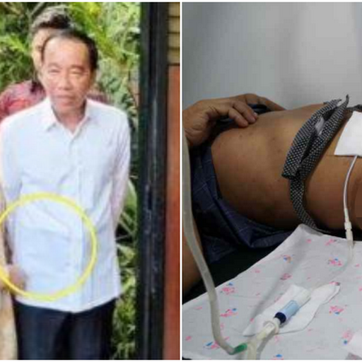 Apa Itu CAPD? Jokowi Disebut Pakai Alat Kesehatan Khusus di Perut saat Ultah ke-64