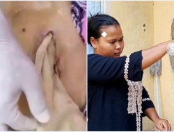 Kisah Pilu Lansia di Bekasi: Meninggal Usai Operasi, Kasa Tertinggal di Perut, RS Bilang SOP