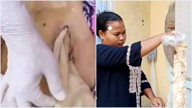 Kisah Pilu Lansia di Bekasi: Meninggal Usai Operasi, Kasa Tertinggal di Perut, RS Bilang SOP