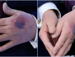 Donald Trump Minum Aspirin Dosis Tinggi, Tangan Memar di Davos Bikin Heboh!